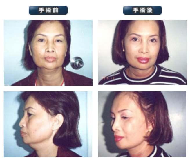 フェイスリフト Thailand Sex Change Surgery Aesthetic Plastic Surgery Cosmetic Surgery Bangkok Plastic Surgery Clinic