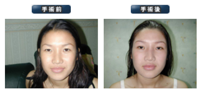 二重まぶた整形 Thailand Sex Change Surgery Aesthetic Plastic Surgery Cosmetic Surgery Bangkok Plastic Surgery Clinic